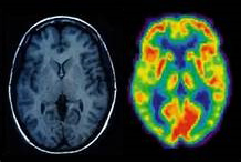 MRI and PET scans of the brain