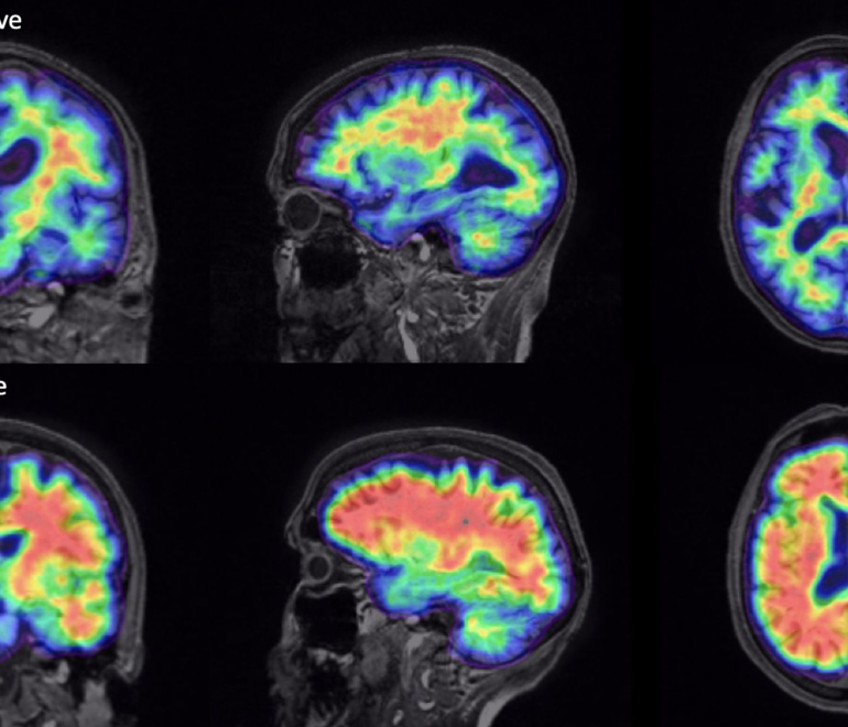 Example of Amyloid positive and negative brain scans