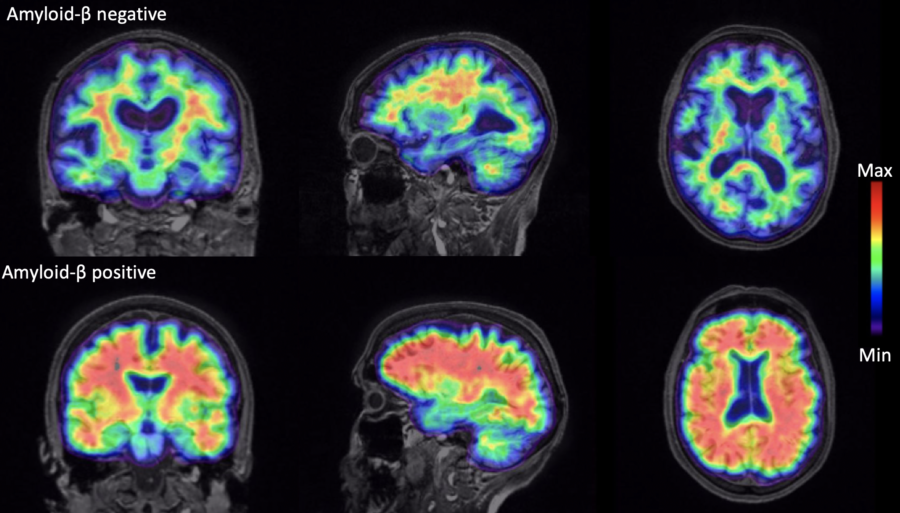 Example of Amyloid positive and negative brain scans